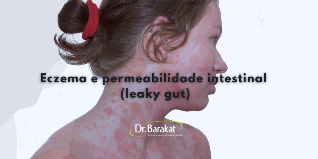 Eczema e permeabilidade intestinal (leaky gut) | Blog do Dr. Barakat